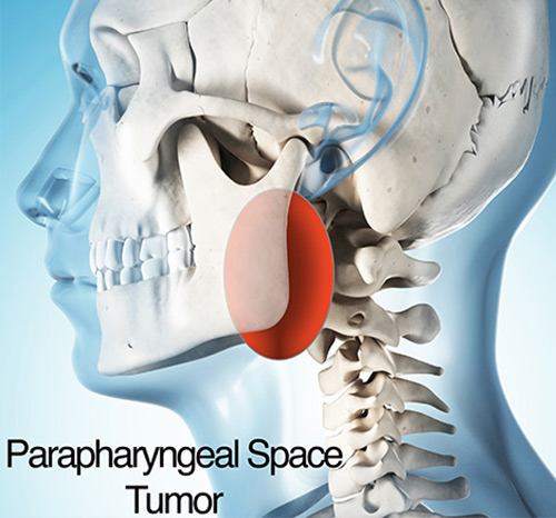 parapharyngeal space